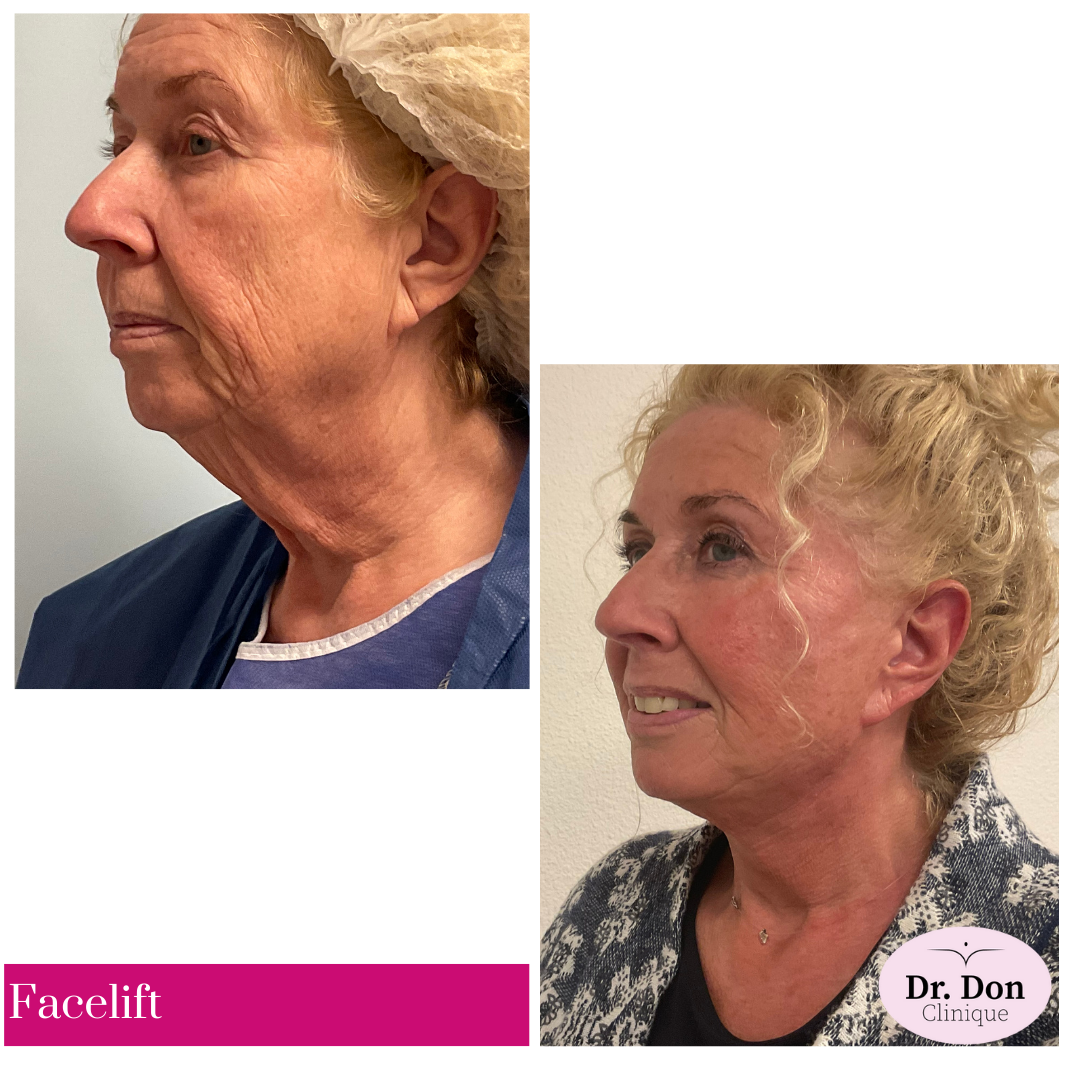 Facelift incl. uitgebreide halslift en bovenooglidcorrectie Facelift incl. uitgebreide halslift en bovenooglidcorrectie